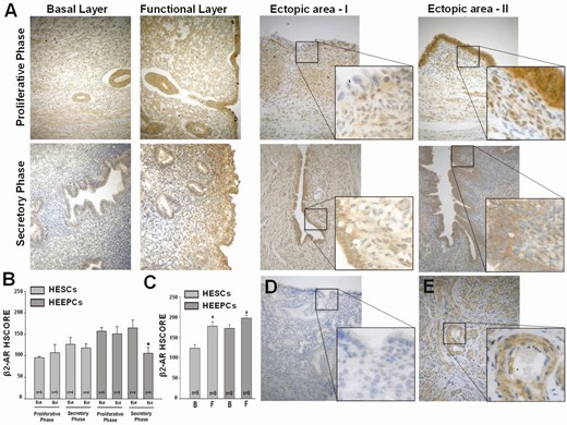 Expression of β2-AR in eutopic and ectopic endometrial tissues. (A) Representative β2-AR immunostaining in endometrial sections from patients with endometriosis during the proliferative and secretory phases in the basal and functional layers of eutopic endometrium as well as their paired ectopic endometrial tissues. Bars in graphs represent means ± standard error of the mean for β2-AR HSCOREs in human endometrial stromal and epithelial cells in eutopic vs ectopic tissues according to (B) menstrual cycle phase or according to (C) location within basalis vs functionalis layers of eutopic endometrium. (D) Negative control of eutopic endometrium displays no immunoreactivity, whereas (E) positive control of myometrium shows moderate-to-strong immunostaining of smooth muscle cells within the tunica media layer of arterioles as well as myometrial smooth muscle cells. *P < 0.05 vs eutopic endometria in secretory phase or vs corresponding basalis layer. AR, adrenergic receptor; B, basalis layer of endometrium; Ect, ectopic; Eut, eutopic; F, functionalis layer of endometrium; HEEPC, human endometrial epithelial cell; HESC, human endometrial stromal cell; HSCORE, histological score. Original magnification 20× with insets 40× (A, D, E).