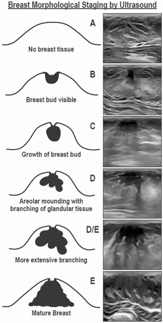 Ultrasound-based breast morphological staging system used in the current studies. The current staging system includes an additional stage, stage D/E, beyond that in Bruni et al (19), Mann et al (20), and Carlson et al (10).