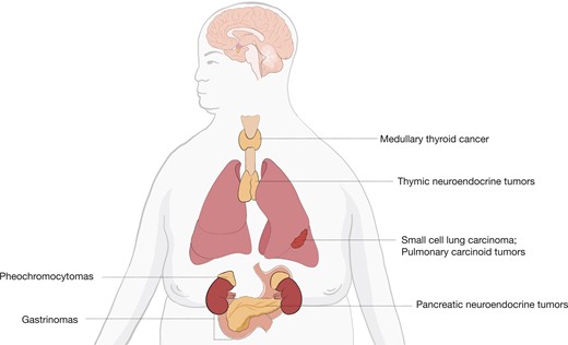Sources of ectopic ACTH secretion. Based on Lacroix et al (2).