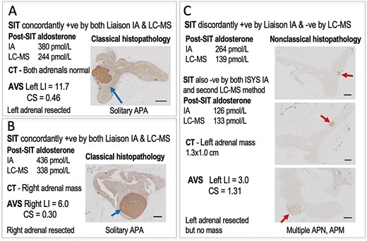 Histopathological analyses of resected adrenals in 3 patients, 2 of whom had concordant positive results of initial saline infusions tests (A & B) and the third patient with positive results for the Liaison immunoassay and negative results for the initial LC-MS/MS methods (C). Data in panels include results of saline infusion tests (SIT), computed tomography (CT) imaging of the adrenals, and adrenal venous sampling (AVS) studies. Abbreviations: APA, aldosterone-producing adenoma; APN, APM, aldosterone-producing nodules or micronodules; CS, contralateral suppression index; IA, immunoassay; LC-MS, liquid chromatography with mass spectrometry; LI, lateralization index.