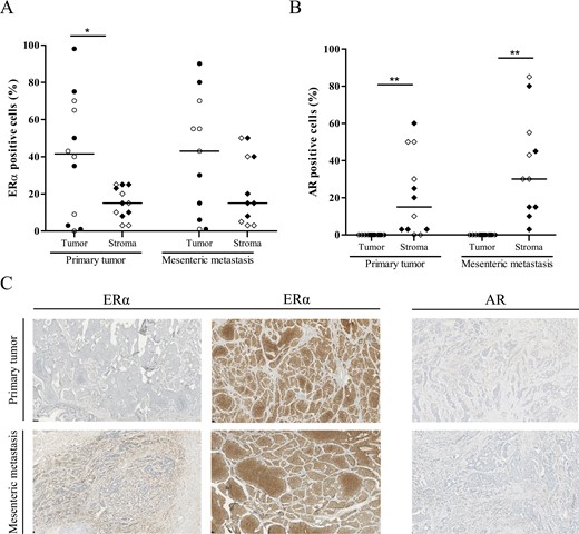 Immunohistochemical analysis of estrogen receptor alpha (ERα) and androgen receptor (AR) expression in primary tumors and paired mesenteric metastases. Percentage of ERα (A) and AR (B) positive tumor and stromal cells is shown by scatter plot of individual data points with median (line). Clear symbols represent male patients; black symbols represent female patients. *P < 0.05, **P < 0.01, tumor vs stromal cells. (C) Photomicrographs of representative tissue slides of immunohistochemical staining for ERα and AR. Upper row shows primary tumors; lower row shows mesenteric metastases. The columns show, respectively, high ERα expression in stromal cells, high ERα expression in tumor cells, and AR expression in stromal cells.
