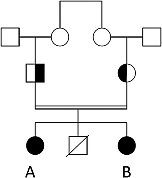 Family tree of the participants. Individuals A and B have a novel, homozygous pro-opiomelanocortin mutation (marked in black). Their parents are heterozygous carriers.