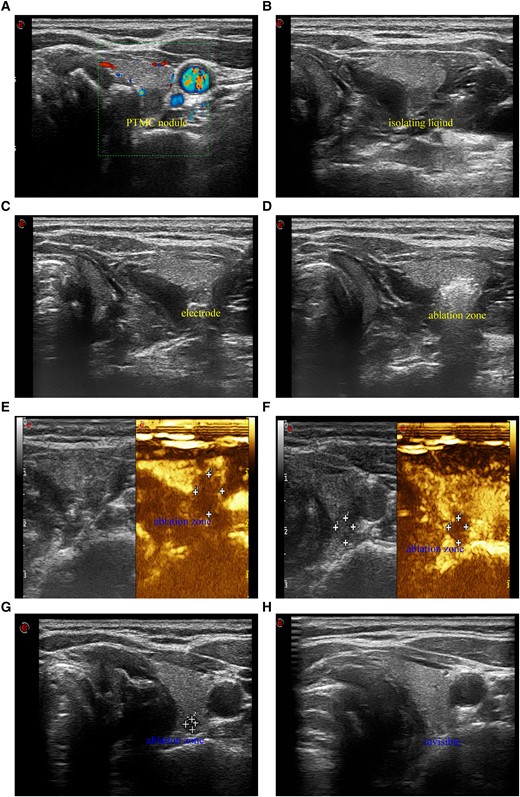 A 39-year-old woman with PTMC nodule and BRAF V600E mutation received ultrasound-guided RFA. A, Color Doppler flow imaging (CDFI) shows a PTMC nodule (5.4 × 5.1 × 4.1 mm) with little signals of blood stream and superior thyroid artery. B, Ultrasound image in transverse view shows that cool sterile water was injected between thyroid tissue, trachea, esophagus, and carotid artery to make the PTMC nodule an isolated island. C, Ultrasound image in transverse view shows that under the protection of isolation fluids, the RF electrode was inserted into the lowest pole of the PTMC nodule through the lateral cervical approach to avoid of damage to superior thyroid artery and the trachea. D, Ultrasound image in transverse view shows that the hyperechoic area covers and exceeds the original PTMC nodule, and extended ablation was achieved successfully. E, Contrast-enhanced ultrasound (CEUS) shows that immediately after RFA the area without enhancement was about 7.9 × 7.8 × 7.1 mm and it exceeded the original size of the PTMC nodule before RFA. F, CEUS shows that 1 month after RFA the area without enhancement was about 5.9 × 5.6 × 5.3 mm and it was smaller than that immediately after RFA. G, Ultrasound image in transverse view shows that 3 months after RFA the ablation zone was significantly reduced (3.0 × 2.1 × 2.1 mm). H, Ultrasound image in transverse view shows that 6 months after RFA the ablation zone was completely invisible.