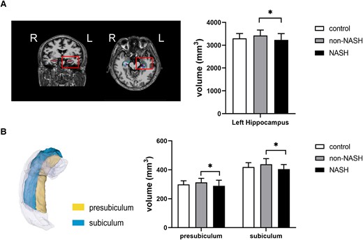 Volumes of left hippocampus and its subfields in the control, non-NASH, and NASH groups. (A) Volumes of the entire left hippocampus. (B) Volumes of the left subiculum and the left presubiculum. L, left. *P < .05 was considered significant.