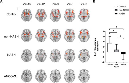 Task-based brain activation in the control, non-NASH, and NASH groups. (A-B) Brain activation in the left hippocampus of subjects in the three groups. Cluster size: 8 voxels. L, left. *P < .05 was considered significant.
