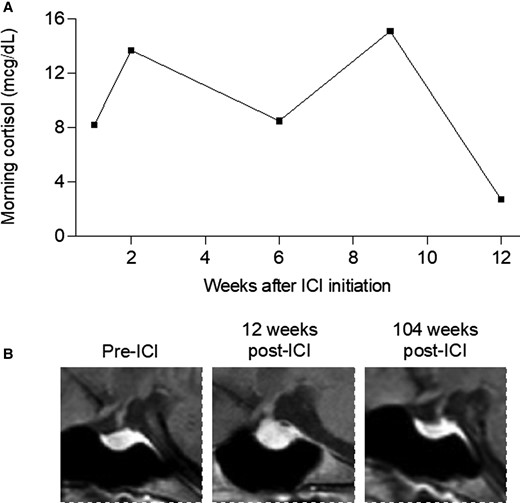 Serial monitoring of morning cortisol levels and MRI images in ICI-hypophysitis. A, Morning serum cortisol was low 12 weeks after ICI initiation, associated with symptoms of fatigue and headache. B, Sagittal plane MRI images of the pituitary, marked with red asterisk, taken before ICI, 12 weeks after ICI while symptomatic, and 104 weeks after ICI with symptoms and hypophysitis resolved.