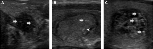 Examples of microcalcifications, indeterminate foci, and comet-tail foci. Punctate hyperechoic foci, less than or equal to 1 mm, within the solid component of the nodule were considered as microcalcifications (A, white arrow). Uncertain punctate hyperechoic foci, with no posterior shadowing or artifacts, in the solid portion of the nodule were considered indeterminate foci (B, white arrow). When the foci were clearly posterior to a cystic area, of triangular shape, or with reverberation artifacts, they were considered as comet-tail foci (white arrowhead, B; white arrows, C).