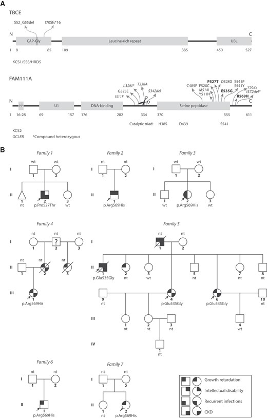 Variants Kenny–Caffey syndrome patients. (A) Top: TBCE is involved in αβ-tubulin dimer formation and dissociation (5-7). KCS1/SSS patient pathogenic variants are located to the CAP-Gly domain that binds the tubulin α-subunit. The vast majority of patients carry the homozygous c.155-166del12 (p.Ser52_Gly55del) pathogenic variant. Bottom: FAM111A is involved in DNA replication (8, 9) and anti-viral defense (10-12). KCS2 and GCLEB (italics) variants in FAM111A show clustering in and around the serine peptidase domain and autocleavage site (scissors). (Likely) pathogenic variants from our case series are shown in bold text. CAP-Gly, cytoskeleton-associated protein-glycine-rich, PIP, PCNA-interacting protein, U1, domain of unknown significance, UBL, ubiquitin-like. *Compound heterozygous variants that were found together in 1 GCLEB patient. (B) Pedigrees of KCS2 patients, indicating patients with symbols partially filled in with black based on their phenotypes. The question mark indicates the person is likely affected but the phenotype is unknown. Probands are indicated with arrows. CKD, chronic kidney disease; nt, not genetically tested; wt, wild type.