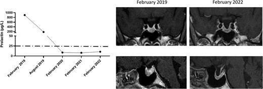 Biochemical and radiological evolution of clinical case 1. The left panel shows changes in PRL levels from diagnosis to the last follow-up. The right panel shows changes in tumor size from the first available MRI to the last follow-up.