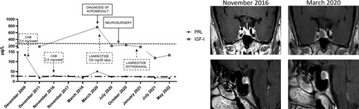 Biochemical and radiological evolution of clinical case 2. The left panel shows changes in PRL levels from diagnosis to the last follow-up. The right panel shows changes in tumor size from the first available MRI to the last follow-up.