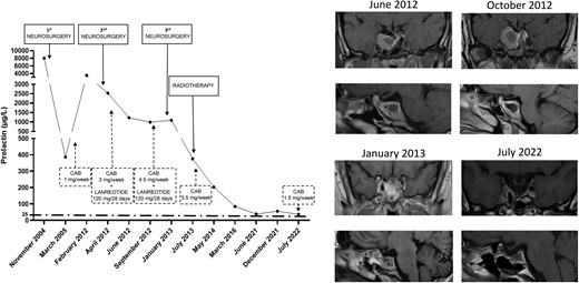 Biochemical and radiological evolution of clinical case 3. The left panel shows changes in PRL levels from diagnosis to the last follow-up. The right panel shows changes in tumor size from the first available MRI to the last follow-up.