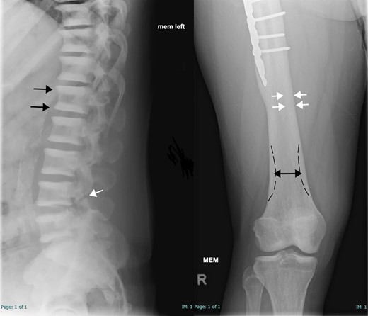 Skeletal survey of subject II-1. Left: Lateral radiograph of the lower thoracic and lumbar spines demonstrated multilevel endplate sclerosis in the vertebral bodies (parallel bands of increased density; black arrows) without appreciable central sclerotic focus. This is commonly described as the “rugger jersey spine.” A chronic L4 pars interarticularis defect is also noted (white arrow). Right: Anteroposterior radiograph of the distal right femur and knee demonstrates femoral cortical thickening (white arrows) and a borderline Erlenmeyer flask shape (club-shaped flaring of long bone metaphysis; double-headed black arrow with dashed black line indicating expected shape). No appreciable bone-in-bone appearance is present. Partial visualization of fixation hardware is visible (#).