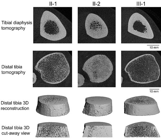 High-resolution peripheral quantitative computed tomography images of the tibia in each family member. Two-dimensional (top 2 rows) and 3-dimensional (bottom 2 rows) views demonstrate the phenotypic diversity in microarchitecture. Subject II-2 (middle column) had significant residual trabecular bone in the medullary cavity at the diaphysis and near solid bone at the distal tibia. Subject II-1 (left column) had some residual trabecular bone at the tibial diaphysis and visibly thicker trabeculae and cortex at the distal tibia when compared to the completely normal looking images of subject III-1 (right column).