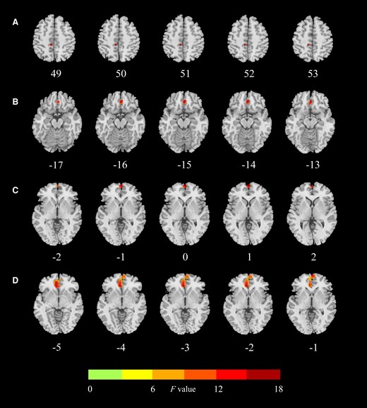 Regions with significant differences in functional connectivity between the hippocampus subfield and the whole brain between HCs, SCH, and OH groups. (A) Significant abnormality of FC values of the right CA3 head–left paracentral lobule among the 3 groups. (B) Significant abnormality of FC values of the right ML head–right frontal medial orbital among the 3 groups. (C) Significant abnormality of FC values of the right ML head–left frontal superior medial among the 3 groups. (D) Significant abnormality of FC values of the left CA4 head–right cingulate anterior among the 3 groups. HCs, healthy controls; SCH, subclinical hypothyroidism. OH, overt hypothyroidism; ML, molecular layer; FC, functional connectivity.
