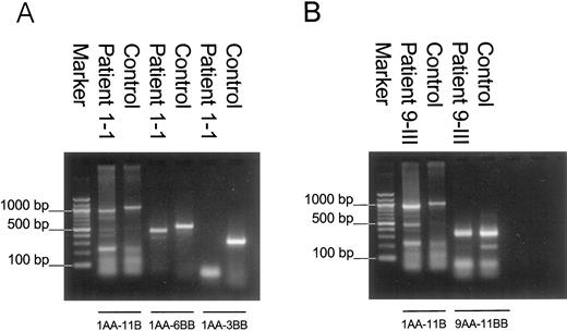 RT-PCR of testicular RNA from patient 1-I homozygous for mutation 325 + 4;A→T (A) and patient 9-III homozygous for mutation 655–1;G→A (B) vs. testicular RNA from a normal healthy male (control).