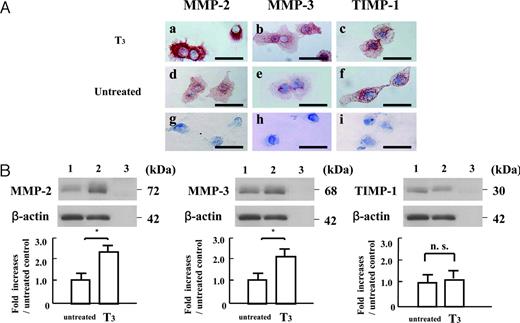 The protein expression of MMP-2, MMP-3, and TIMP-1 in cultured early placental EVTs after 48-h subsequent culture on FN-precoated dishes, as assessed by immunocytochemical and Western immunoblot analyses. A, Immunocytochemical detection of MMP-2, MMP-3, and TIMP-1 in cultured early placental EVTs after 48-h subsequent culture in the presence or absence of T3 (10−8m). MMP-2, MMP-,3 and TIMP-1 proteins were abundant in the cytoplasm of cultured EVTs after 48-h subsequent culture. Replacement of the primary antibody with nonimmune rabbit or goat IgG resulted in a lack of positive immunostaining in the cultured EVTs (g–i). The expression of MMP-2 and MMP-3 in cultured EVTs treated with T3 was more abundant than that in untreated cultures. However, there was no apparent change in the expression of TIMP-1 protein between the cultured EVTs treated with T3 and untreated cultures. Bars, 50 μm. B, Western immunoblot analyses of MMP-2, MMP-3, and TIMP-1 in cultured early placental EVTs after 48-h subsequent culture in the presence or absence of T3 (10−8m). Each 200-μg aliquot of proteins extracted from cells after 48-h subsequent culture was subjected to Western immunoblot with polyclonal antibodies to recombinant MMP-2, MMP-3, and TIMP-1 proteins as described in Materials and Methods. The amounts of MMP-2, MMP-3, and TIMP-1 proteins were expressed relative to the abundance of β-actin protein. Data were presented as the fold increases over the average intensity of β-actin protein. Treatment with T3 significantly increased the expression of 72-kDa MMP-2 and 68-kDa MMP-3 in the cells compared with those in untreated cultures (P < 0.05), whereas the expression of 30-kDa TIMP-1 in the cells treated with T3 was comparable with that in untreated cultures. Experiments were repeated five times with similar results for each. Lane 1, Untreated cultures; lane 2, T3 (10−8m)-treated cultures; lane 3, negative control. Each value is expressed as the mean ± sd. *, P < 0.05. n.s., Not significant.