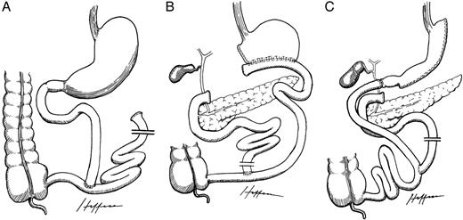 Malabsorptive bariatric operations. A, Jejunoileal bypass; B, biliopancreatic diversion; C, duodenal switch. Drawings rendered by Dr. Alejandro Heffess and generously provided by Edward C. Mun.