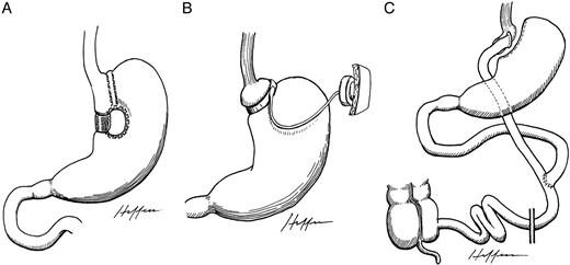 Restrictive bariatric operations. A, Vertical banded gastroplasty; B, adjustable gastric banding; C, Roux-en-Y gastric bypass. Drawings were rendered by Dr. Alejandro Heffess and generously provided by Edward C. Mun.