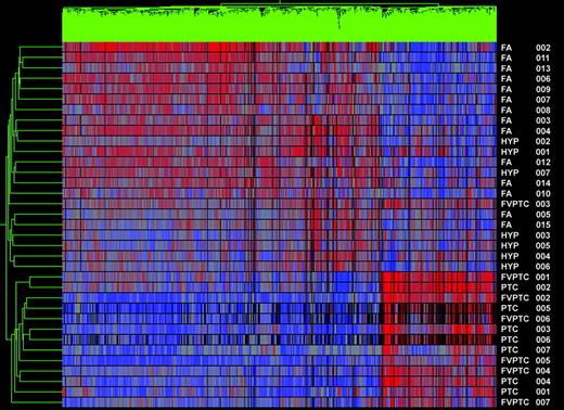 Gene cluster 1. Dendrogram of cluster analysis of 14 PTCs (seven PTC and seven FVPTC) and 21 benign nodules (FAs and hyperplastic nodules) based upon the pattern of expression of 1149 differentially expressed genes. Red indicates relatively high expression; blue indicates low levels of expression. Sample names are listed at the right of the diagram.