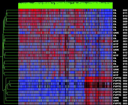 Gene cluster 2. Dendrogram of cluster analysis of 11 FVPTC (including three unknowns labeled UNK 4–6) and 23 benign nodules (FAs, hyperplastic nodules, and UNK 1–2) based upon the pattern of expression of 873 differentially expressed genes. Red indicates relatively high expression; blue indicates low levels of expression. Sample names are listed at the right of the diagram.