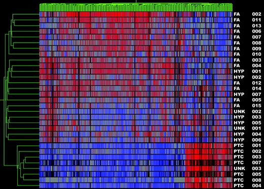 Gene cluster 3. Dendrogram of cluster analysis of eight PTC (including UNK 3) and 23 benign nodules (FAs, hyperplastic nodules, and UNK 1–2) based upon the pattern of expression of 483 differentially expressed genes. Red indicates relative high expression; blue indicates low levels of expression. Sample names are listed at the right of the diagram.