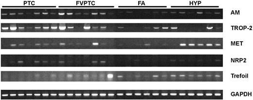 Semiquantitative RT-PCR. Verification of highly differentially expressed genes specific for carcinoma or benign tissue. Adrenomedullin (AM), TROP-2, MET, and NRP2 were differentially overexpressed in the carcinomas. Trefoil (intestinal trefoil factor) was relatively overexpressed in benign nodules. Primers specific for glyceraldehyde-3-phosphate dehydrogenase (GAPDH), a housekeeping gene, were used as controls. All carcinoma samples (PTC and FVPTC) and 12 of the benign nodules [FA and hyperplastic nodules (HYP)] are displayed. Band intensity levels were normalized to the housekeeping gene and compared using a t test. All differences seen are statistically significant (P < 0.05).