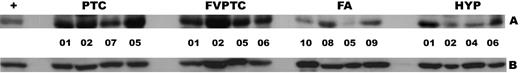 Immunoblot. The differential expression of NRP2 was confirmed by Western blot analysis. One hundred micrograms of protein per lane were loaded. Blot A, The first eight samples (left) are from carcinomas (PTC and FVPTC); the next eight samples (right) are from benign nodules (FA and hyperplastic nodules (HYP)]. Blot B, β-Actin was used as an internal control.