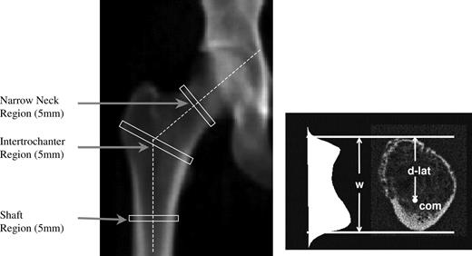 DXA image showing location of HSA regions and an example of a cross-section through the NN region to show the bone mass profile, center of mass (com), bone width (w) and the distance from the center of mass to the lateral cortical margin (d-lat).