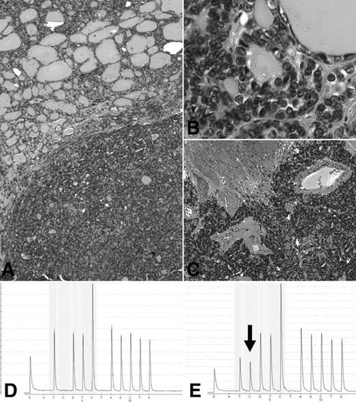 Molecular profile of a poorly differentiated thyroid carcinoma (A) with residual component of follicular variant of papillary carcinoma (A, top, and B) and predominant solid component with extensive necrosis (A, bottom, and C), showing by means of pyrosequencing analysis the presence of wild-type NRAS in the normal peritumoral thyroid (D) and heterozygous mutation at codon 61 in the tumor (E; reverse sequence showing the presence of an additional peak corresponding to the NRAS Q61R-CAA > CGA-substitution).