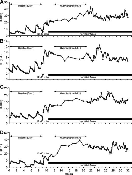 Serum LH profiles of four individual subjects receiving 4 μg/kg · h kisspeptin-10 infusion (black bar) after 9 h baseline sampling and 3 μg/kg iv bolus administered at 9 h (black arrow). Serum samples were obtained at 10 min intervals except overnight when samples were obtained hourly. Note the difference in scale between individual subjects.