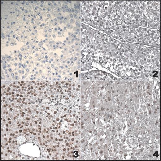 1～4例肿瘤组织p53免疫组化染色（400×），3、4例呈阳性染色，核聚积。1、患者1（图片由W.Saeger教授提供）；2例患者2例；3例患者3例；患者4例。