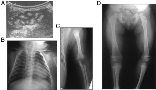 Radiographic features of the female patient.