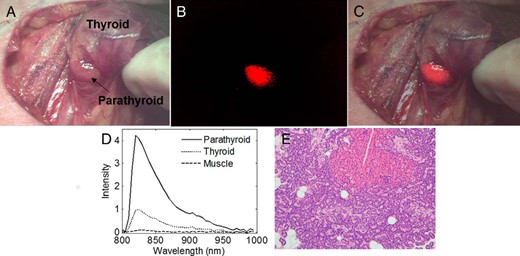 Intraoperative fluorescence images of the parathyroid gland.