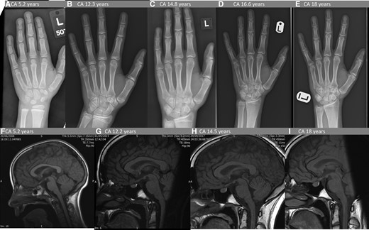 Serial pituitary MRI and bone age radiology. Upper panel shows serial bone age X-rays. (A) At diagnosis chronological age (CA) 5.2 years, bone age (BA) 6.9 years. (B) At the start of pegvisomant treatment CA 12.3 years, BA 13.5 years. (C) Stable on pegvisomant, BA advancement resolved CA 14.8 years, BA 15 years. (D) Linear growth had resumed CA 16.6 years, BA 16 years. (E) At final height CA 18 years, BA 17.6 years (ie, mature). Lower panel: 4 of 10 serial pituitary MRI scans. All demonstrate slightly bulky but not enlarged pituitary of homogenous texture and enhancement; appearance and size and unchanged throughout the 13-year period. Sagittal T1-weighted images with gadolinium contrast (F) at diagnosis, (G) at the start of pegvisomant treatment at CA 12.3 years, (H) 2.3 years after pegvisomant treatment started, (J) 5.8 years after pegvisomant treatment started; (K) at CA 18 years.