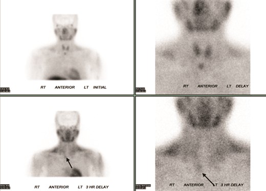 Technetium-99m Sestamibi scintigraphy showed persistent increased uptake (arrows) below the right lobe of the thyroid gland during the delayed phase.