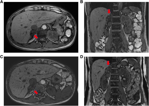 A, B, Adrenal gland on magnetic resonance imaging before pregnancy (T1 weighted, out of phase). Solid arrows indicate the right adrenal mass (34 mm ×24 mm ×22 mm). C, D, Adrenal gland on magnetic resonance imaging at 14 weeks of pregnancy (T1 weighted, out of phase). Solid arrows indicate the right adrenal mass (32 mm ×24 mm ×21 mm). There were no remarkable changes in size or features between examinations.