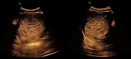 Ultrasound image of the 10-cm molar pregnancy invading the myometrium.