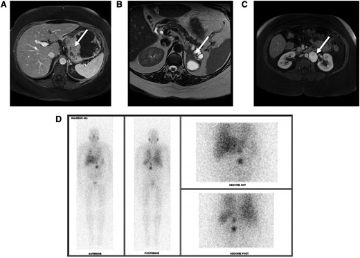(A) Magnetic resonance imaging (MRI) scan showing a 10-cm GIST with apparent origin in the gastric body and fundus (white arrow). (B) Axial T2-weighted MRI showing a 7-cm left solid cystic pheochromocytoma (white arrow). (C) Axial T2-weighted MRI indicating 4-cm para-aortic paraganglioma (white arrow). (D) Meta-iodine-benzyl-guanidine labeled with iodine 131 (131I-MIBG) scan demonstrating a high uptake in the left para-aortic and adrenal lesions. GIST, gastrointestinal stromal tumor.