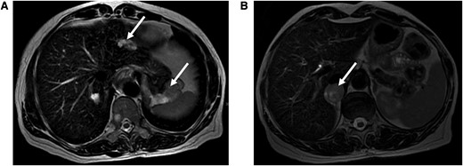 (A) Axial T2-weighted magnetic resonance imaging (MRI) scan indicating an 8-cm GIST and a metastatic GIST liver lesion (white arrows). (B) Axial T2-weighted magnetic MRI scan showing a 3-cm right pheochromocytoma (white arrow). GIST, gastrointestinal stromal tumor.
