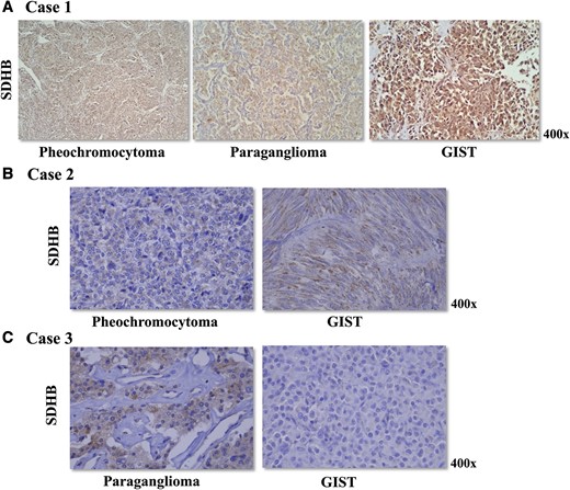(A) Immunohistochemistry for SDHB was positive in the pheochromocytoma, paraganglioma, and GIST of case 1. Genetic investigation for SDHx pathogenic variants and large deletions was negative in the germline DNA and all 3 tumors samples from case 1. (B) Pheochromocytoma and GIST of case 2 displayed a positive staining for SDHB. Case 2 did not harbor germline pathogenic variants or large deletions in the SDHx genes. (C) Case 3 harbored a germline SDHC exon 3 deletion. Immunohistochemistry for SDHB was positive in the paraganglioma. GIST displayed a negative staining for SDHB, suggesting a second somatic event in the SDHC (such as promoter hypermethylation).