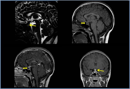 The visual field examination revealed an incision in the upper sector of the central isopter and an enlargement of the blind spot.