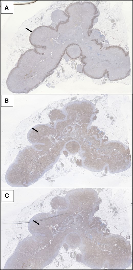 Demonstrates continuous, substantial CYP11B2 (aldosterone synthase) expression in the zona glomerulosa of the adrenal (panel A). CYP17A1 (17-hydroxylase/17,20-lyase, the target of Abiraterone) (Panel B) and CYP11B1 (11-hydroxylase) (Panel C) are expressed throughout the remainder of the adrenal cortex down to the medulla.