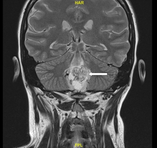 A magnetic resonance image of the brain. Arrow indicates a 2.6 × 2.1 × 2.7 cm hemangioblastoma centered in the dorsal medulla extending across the floor of the fourth ventricle with cystic and solid components and flow voids posteriorly.