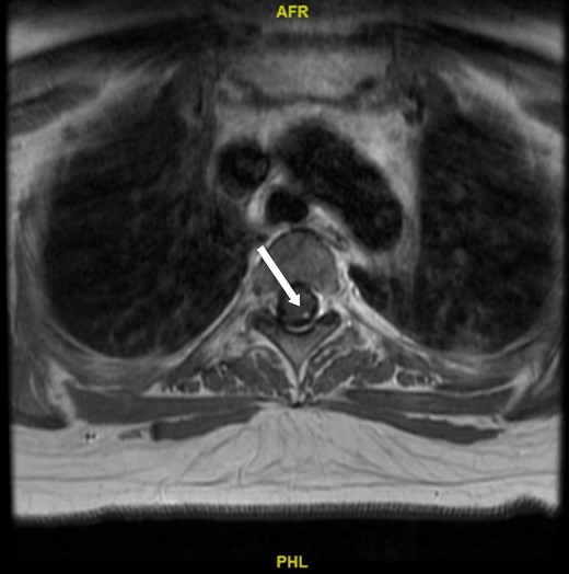 A magnetic resonance image of the spine. Arrow indicates a 2 × 4 mm hemangioblastoma seen along the left posterior thoracic spinal cord at T3 to T4.