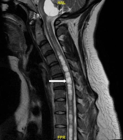 A magnetic resonance image of the spine. Arrow indicates an associated syrinx formation of the spinal cord starting at the level of C3 to C4 and extending to the level of T3 to T4 measuring up to 9 mm in diameter.