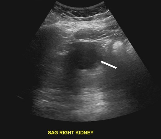 An ultrasound of the kidneys. Arrow indicates a minimally complex cyst seen along the right kidney measuring 4.5 cm.