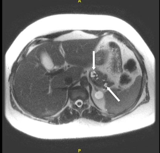 A magnetic resonance image of the abdomen and pelvis. Arrows indicate numerous pancreatic cysts, the largest measuring about 1.6 cm in the distal body, without definite ductal communication.