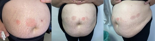 Well-defined, round erythematous plaques surrounding the injection site of liraglutide.