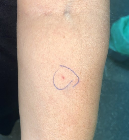 A positive delayed reaction of intradermal testing to liraglutide with 1/1 dilution.