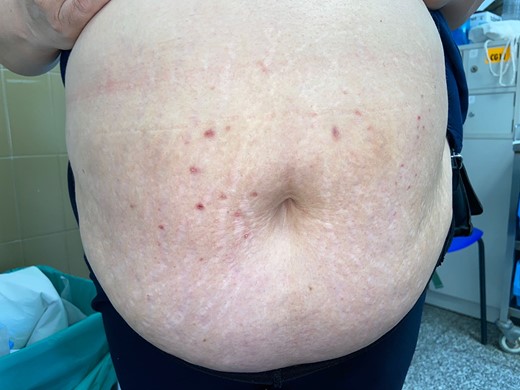 Small, postinflammatory hyperpigmented papules at the sites where the initial lesions were, 6 weeks after treatment cessation.